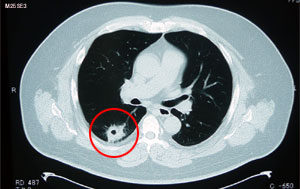 がん症例報告（スマホで画像拡大可能です